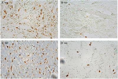 Two tripartite classification systems of CD86+ and CD206+ macrophages are significantly associated with tumor recurrence in stage II-III colorectal cancer